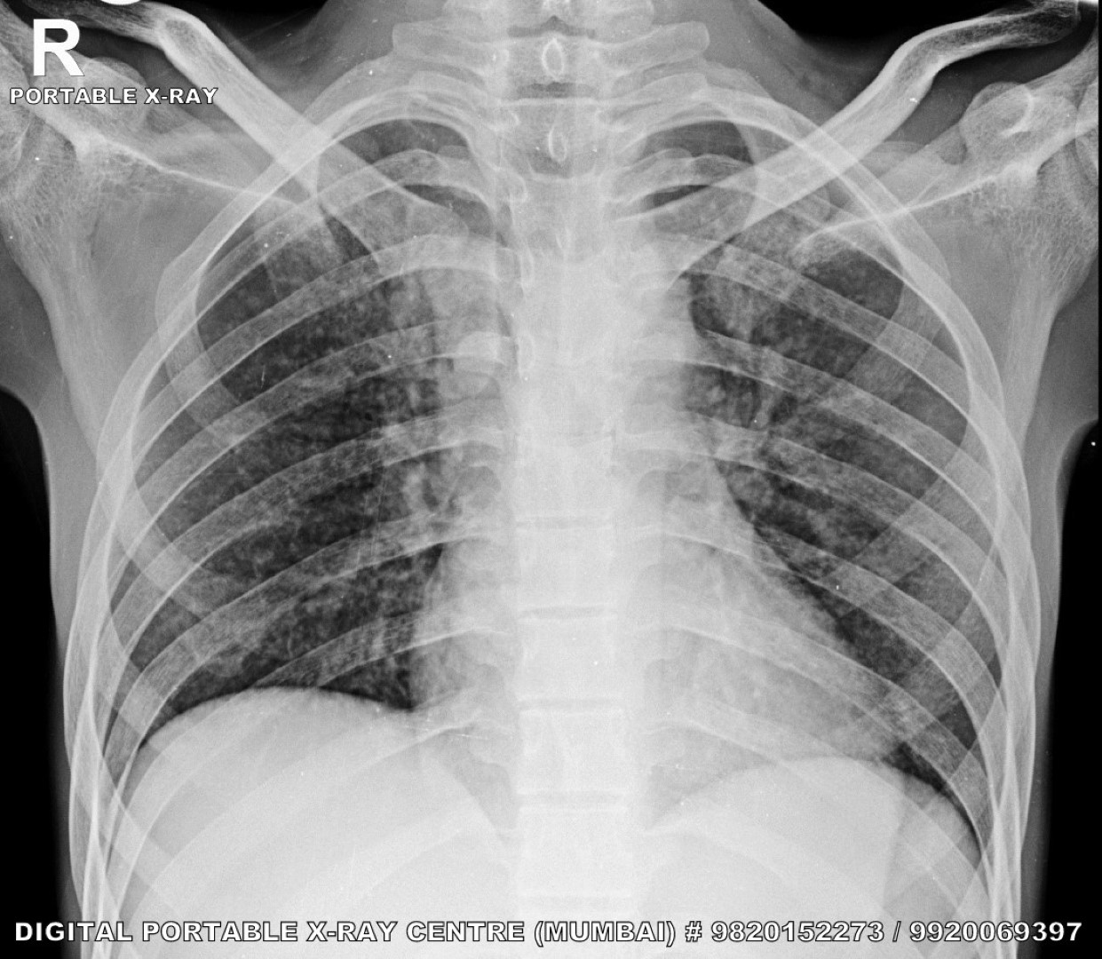 Portable X-ray device